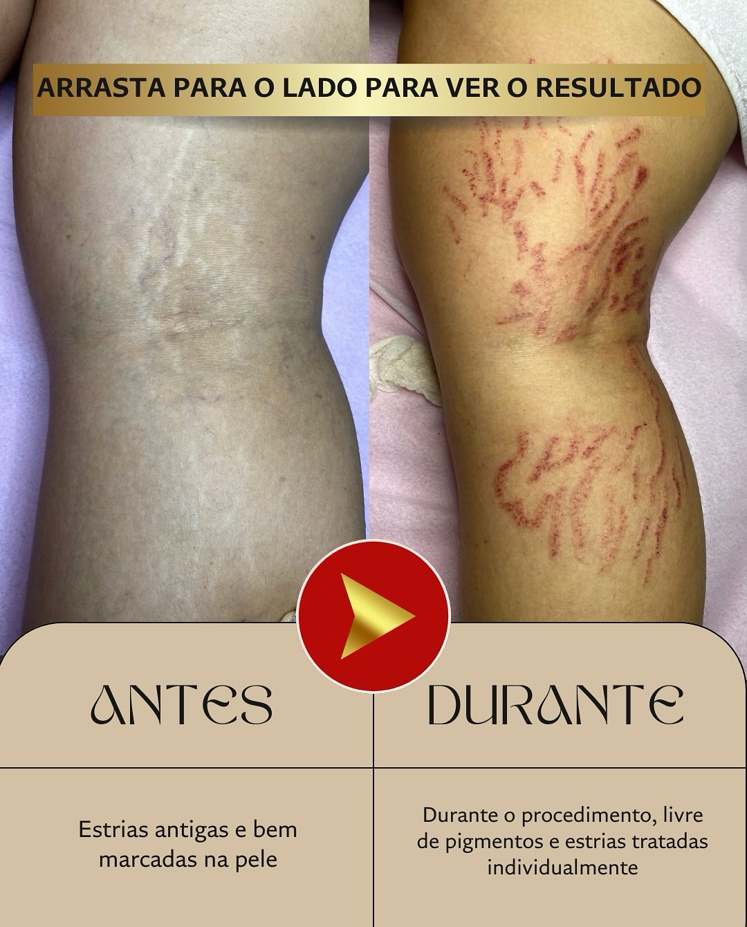 Antes do tratamento de Estrias - Método Microrenova