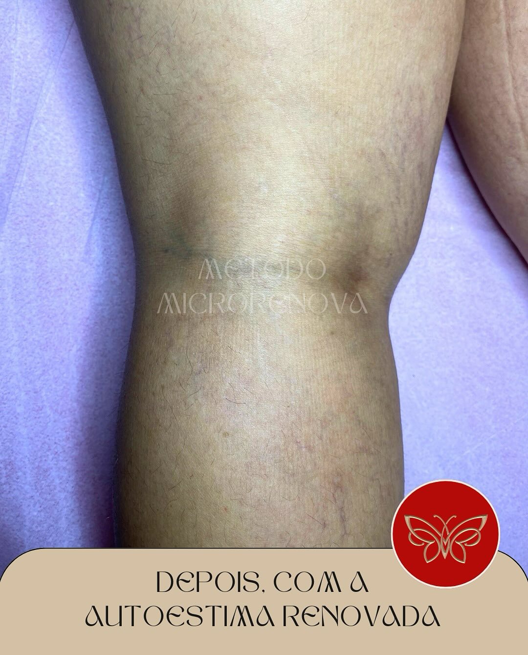 Depois do tratamento de Estrias - Método Microrenova