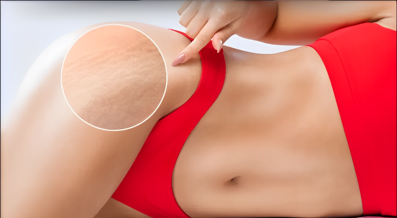 Tratamento de Estrias com Microrenova em Portugal